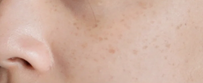 黃褐斑可以去除嗎