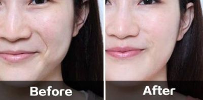 打完法令紋晚上疼一晚怎么回事