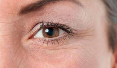 怎樣去除眼角魚尾紋