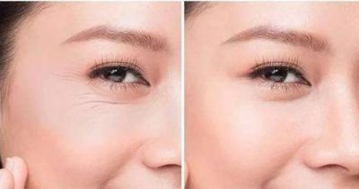 怎樣去除眼角魚尾紋