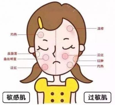 紅敏肌自己怎么改善