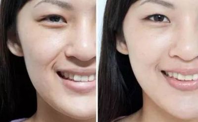 為什么年紀小就有法令紋