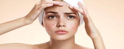 額頭長痘痘的護理方法