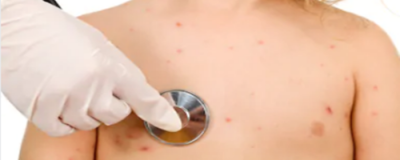 臉頰長痘痘怎么回事