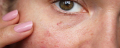 怎樣消除紅血絲