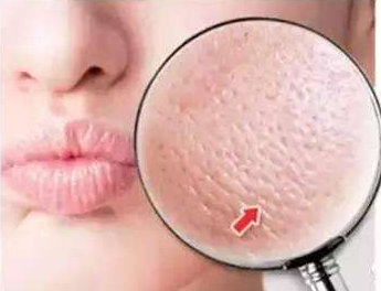 青春期最簡單的收縮毛孔方法