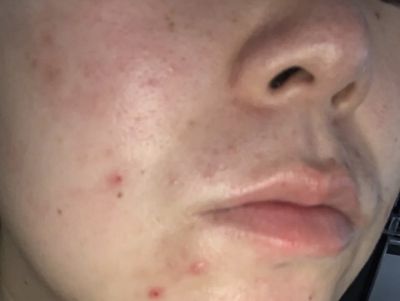 1149452011308 巴赫復欣可以修復好皮膚嗎