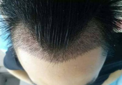 m字型發際線怎么辦