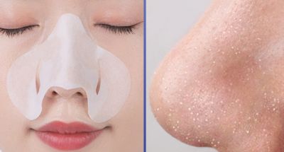 擠黑頭擠出來的白色東西是什么