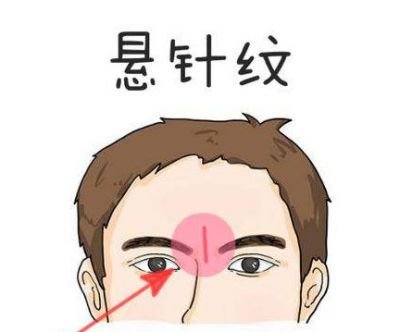 額頭中間的豎紋怎樣能去掉