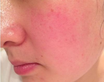 敷面膜后臉紅發燙是怎么了