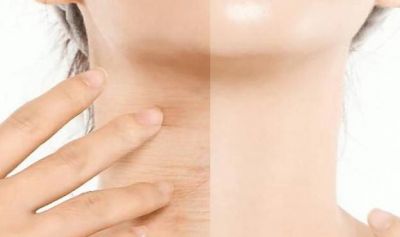 脖子黑怎么有效變白的方法