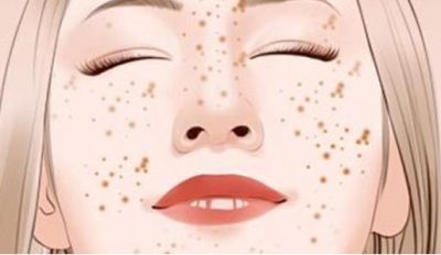 1310212911311 孕婦長雀斑怎么會遺傳嗎