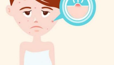 痘痘肌用什么護膚品對皮膚好