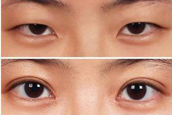 誰做過單眼皮還原