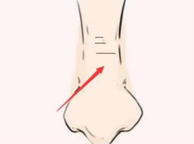 如何去除鼻梁紋方法