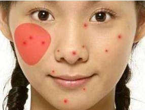 臉頰兩邊老是長痘痘是怎么回事