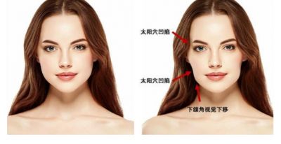 臉顴溝怎么消除