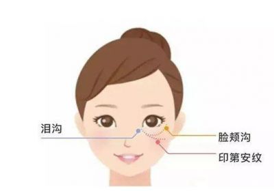 印第安紋可以用玻尿酸填充嗎