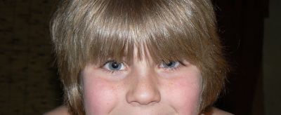 怎樣可以淡化雀斑