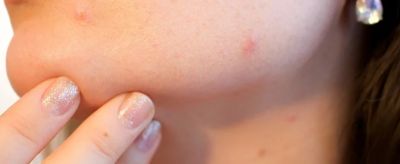 臉上長粉刺是什么原因