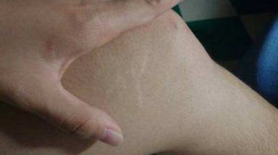 皮膚撐開長紋怎么消除