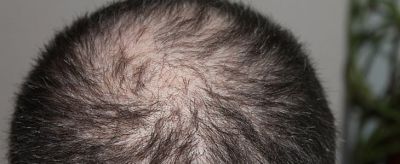 后腦勺出汗是怎么回事