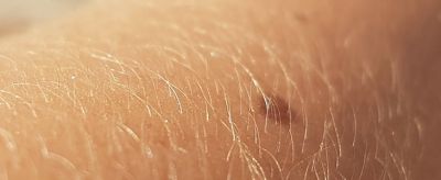 可以永久性脫毛嗎