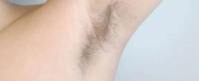 可以永久性脫毛嗎