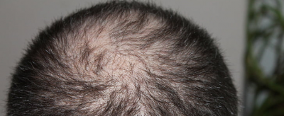 頭發掉的厲害怎么回事