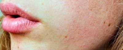 春季皮膚干燥起皮怎么辦