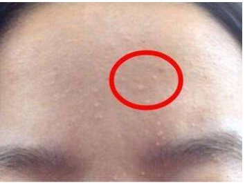 額頭老是長閉口是什么原因