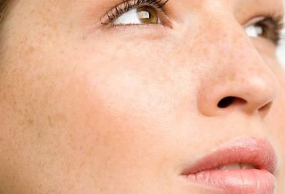 臉部點斑怎么辦