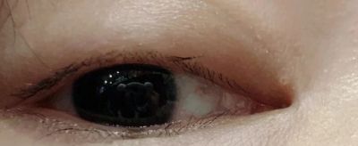 怎樣去除眼部脂肪粒