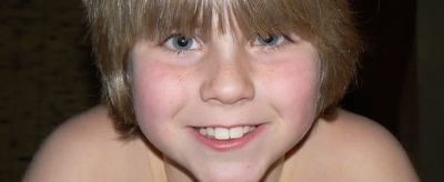 皮膚有紅血絲怎么辦