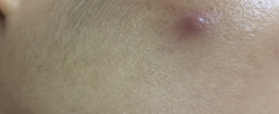 2149027811310 去痘痘的簡單方法