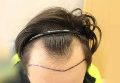 正常m型發際線是怎么樣的