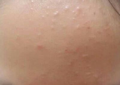 用護膚品起小米粒疙瘩怎么回事