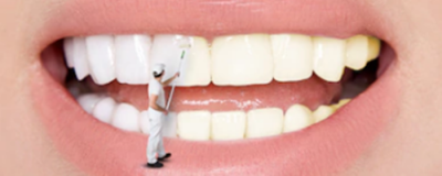 美白牙貼有用嗎