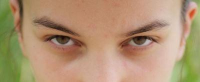 痤瘡怎么形成的