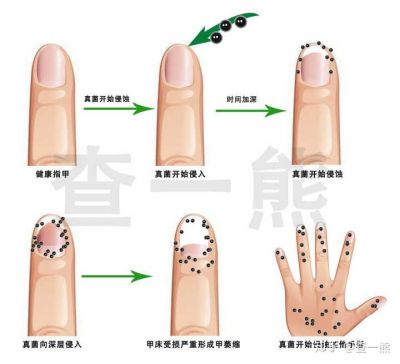 治療灰指甲亮甲好用還是楚甲