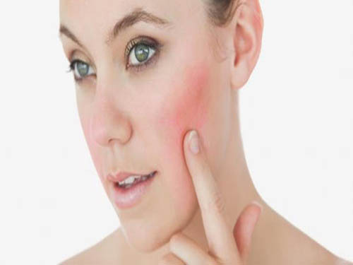 夏天熱臉上癢怎么辦