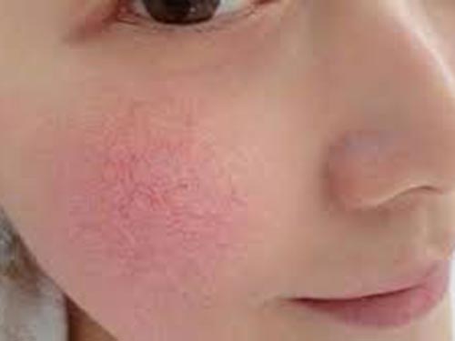 臉紅發熱是怎么回事