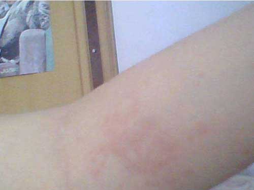 8_2019625104703107_4 皮膚過敏癢怎么辦