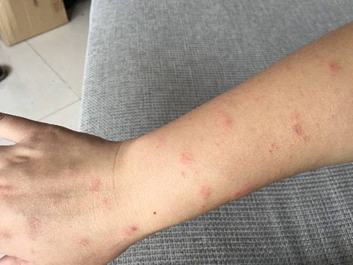 8_2019628114803320_4 紅斑皮疹是怎么引起的