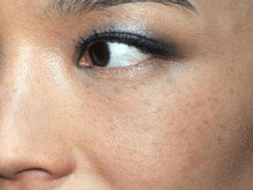 8_2019716173901107_4 色斑是怎么形成的