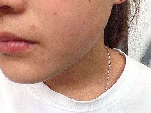 臉上有坑怎么修復