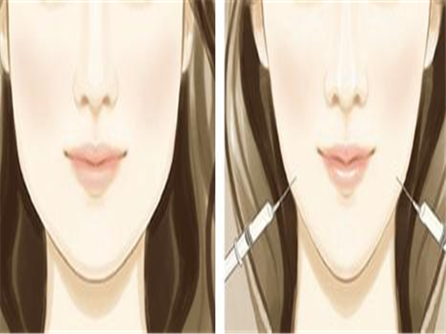 8_2020111142009542_4 瘦臉針是永久的嗎