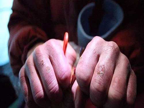 凍瘡疤痕怎么消除