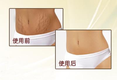 去妊娠紋哪個牌子好